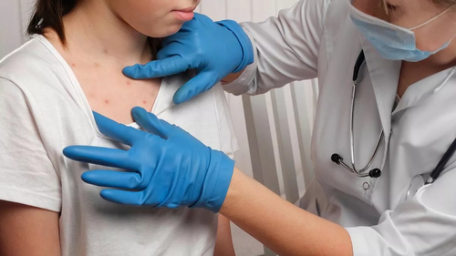 Latest company news about Measles: Spreading Fast. How Can You Stay Safe?