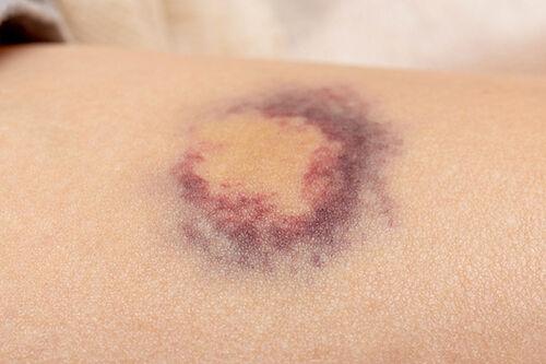 Latest company blogs about The Hidden Signs of Skin Cancer You Might Be Missing