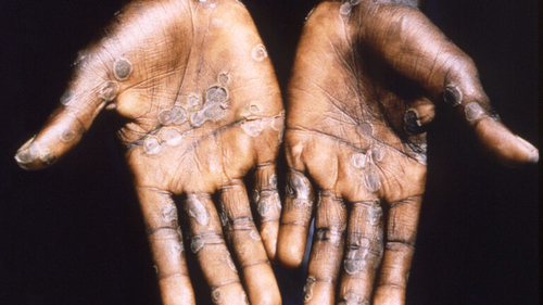 Latest company news about Monkeypox outbreak poses ‘moderate risk’ to global public health, WHO says